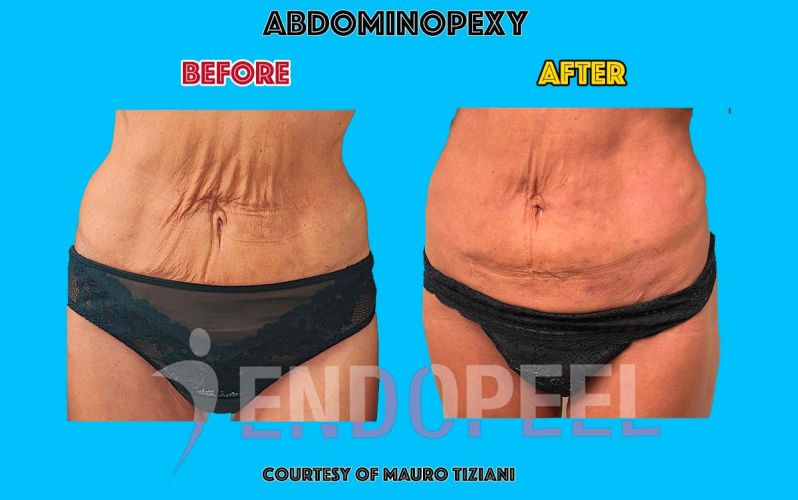 abdominopexy